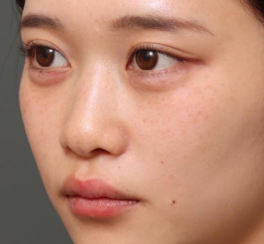 10代女性のヒアルロン酸注射（涙袋） After 症例写真