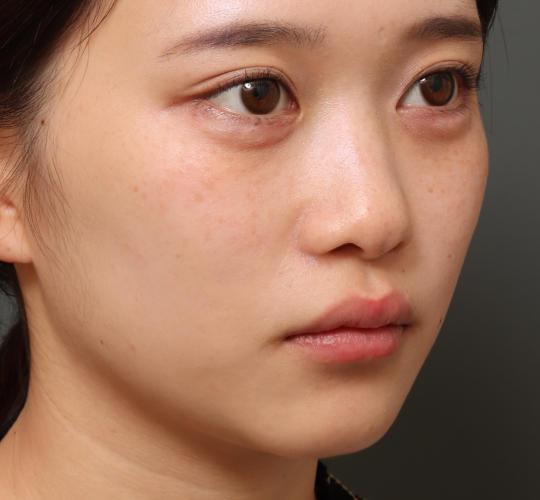 10代女性の二重整形・目元の整形 After 症例写真