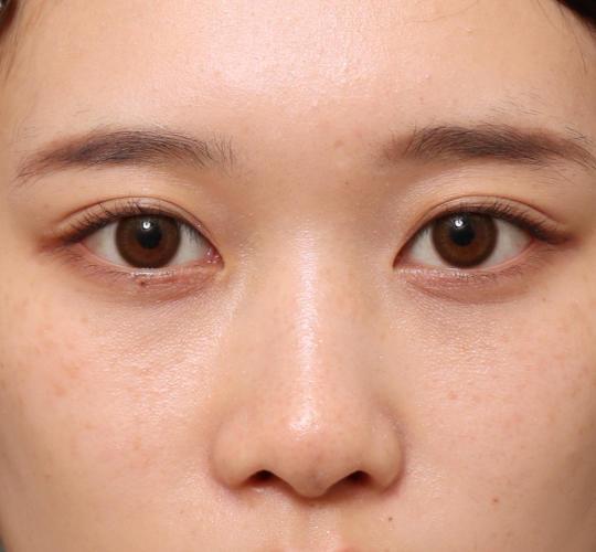 10代女性のヒアルロン酸注射（涙袋） Before 症例写真