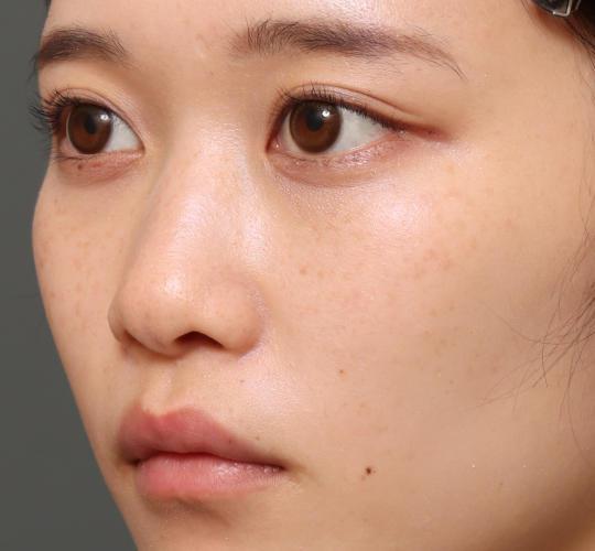 10代女性のヒアルロン酸注射（涙袋） Before 症例写真