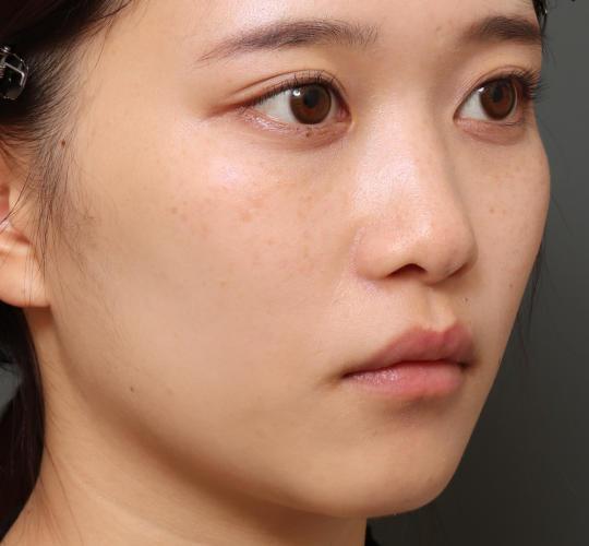 10代女性の二重整形・目元の整形 Before 症例写真