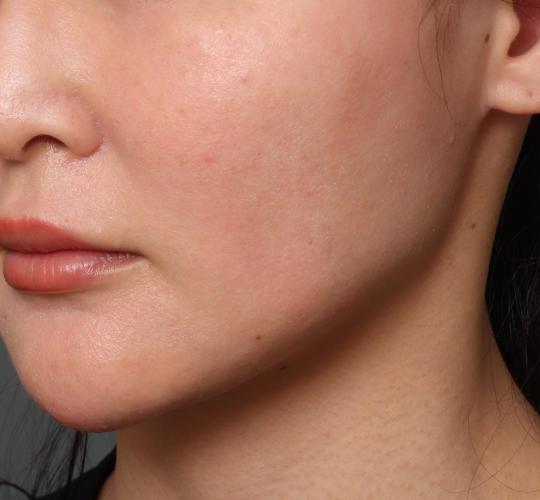 30代女性のフェイスタイト After 症例写真