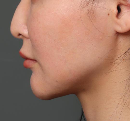 30代女性のフェイスタイト After 症例写真