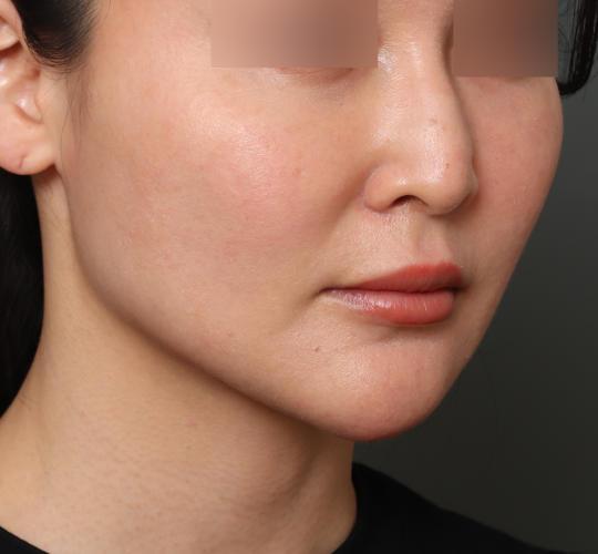 30代女性のフェイスタイト After 症例写真