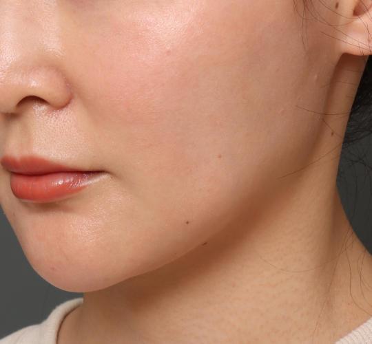 30代女性のフェイスタイト Before 症例写真