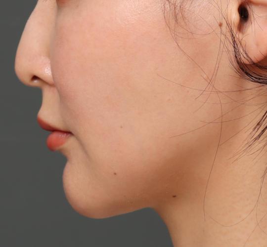 30代女性のフェイスタイト Before 症例写真