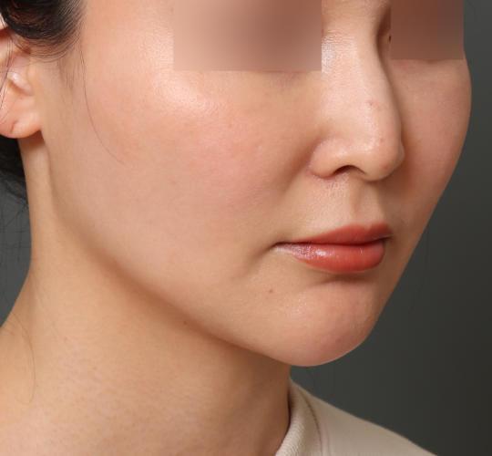 30代女性のフェイスタイト Before 症例写真