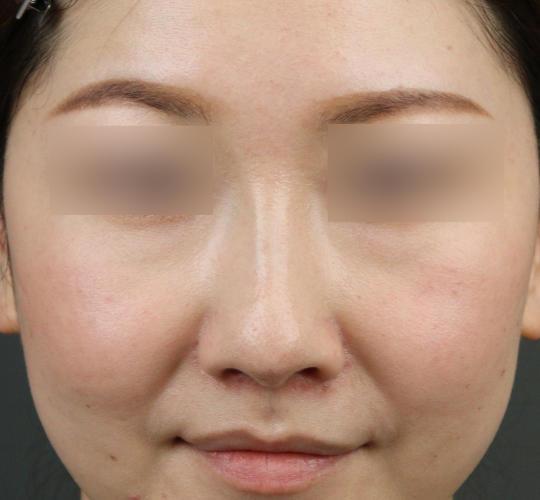 30代女性のテスリフトノーズ After 症例写真