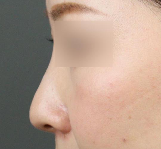 30代女性のテスリフトノーズ After 症例写真