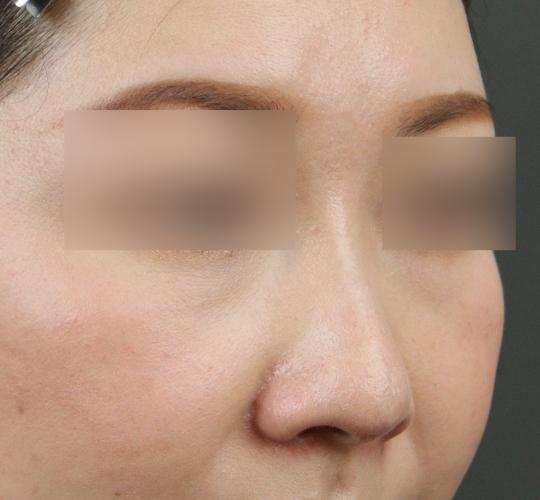 30代女性の鼻の整形 After 症例写真