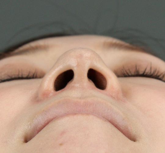 30代女性のテスリフトノーズ After 症例写真