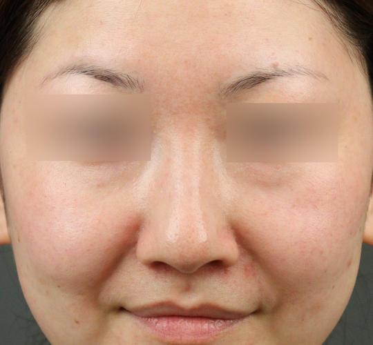 30代女性のテスリフトノーズ Before 症例写真