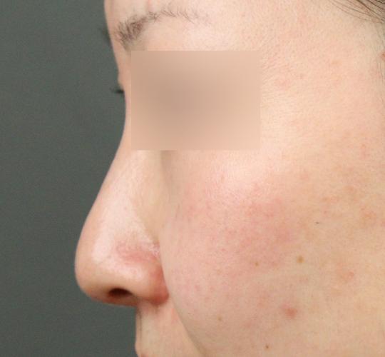 30代女性のテスリフトノーズ Before 症例写真