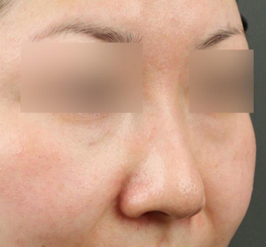 30代女性の鼻の整形 Before 症例写真
