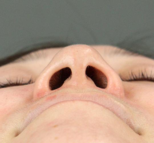 30代女性のテスリフトノーズ Before 症例写真