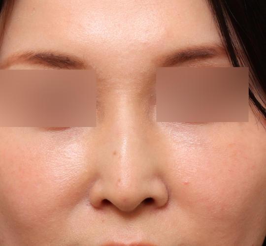 30代女性のテスリフトノーズ After 症例写真