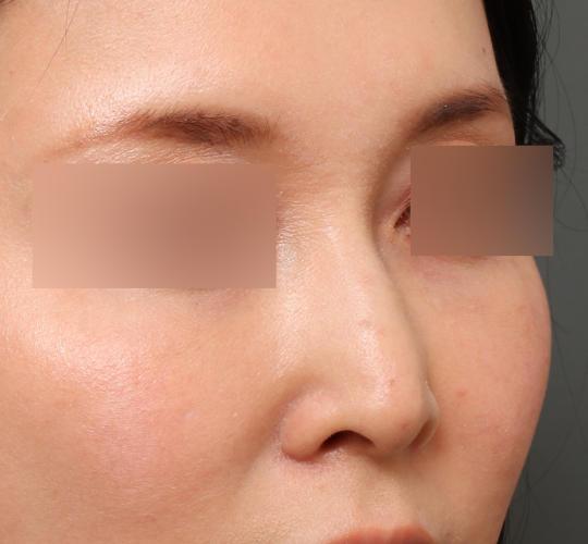 30代女性のテスリフトノーズ After 症例写真