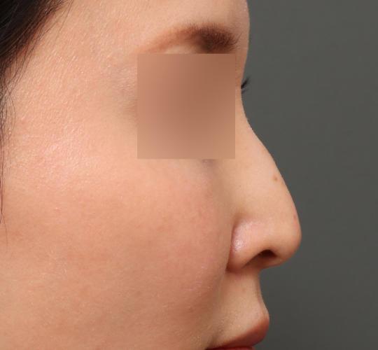 30代女性の鼻の整形 After 症例写真