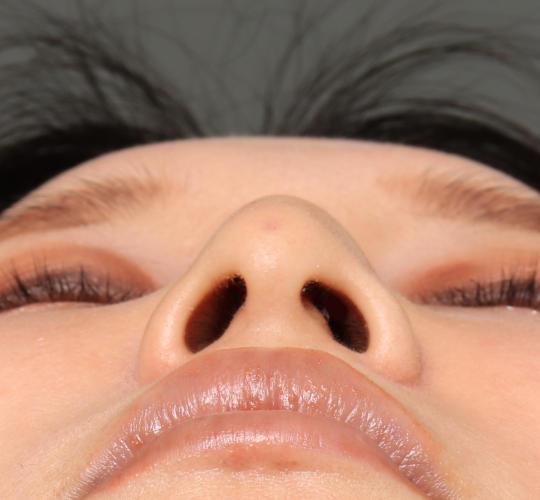 30代女性のテスリフトノーズ After 症例写真