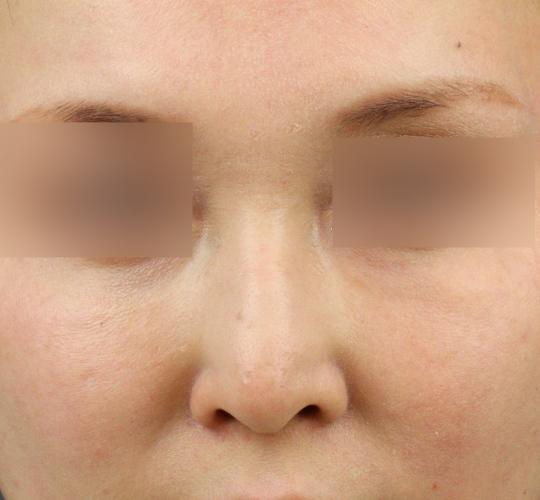 30代女性のテスリフトノーズ Before 症例写真