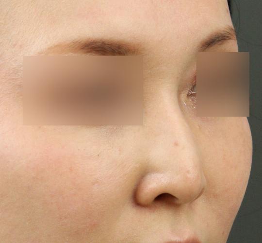 30代女性のテスリフトノーズ Before 症例写真