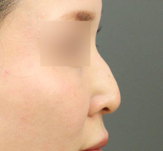 30代女性の鼻の整形 Before 症例写真