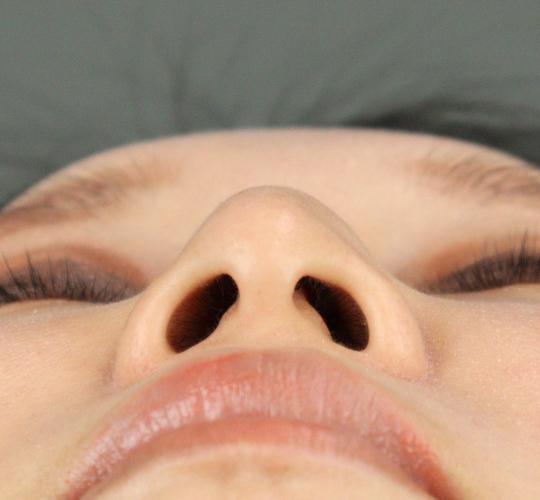 30代女性のテスリフトノーズ Before 症例写真