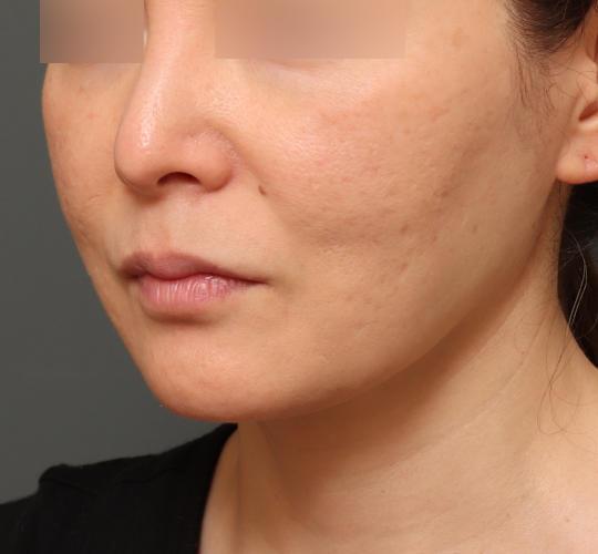 40代女性のボトックス(小顔) After 症例写真
