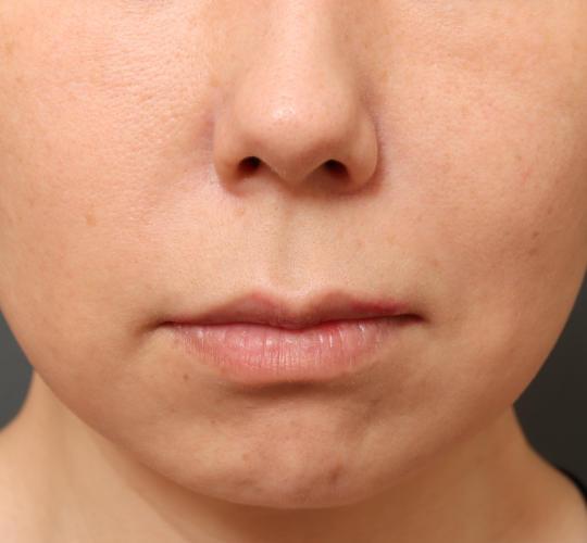 40代女性の人中短縮(リップリフト) Before 症例写真