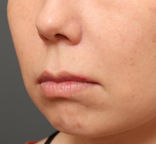 40代女性の人中短縮(リップリフト) Before 症例写真