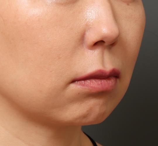 40代女性の人中短縮(リップリフト) Before 症例写真