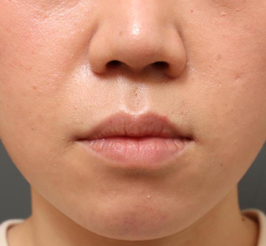 30代女性の鼻翼拳上 Before 症例写真
