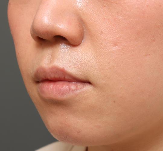 30代女性の鼻翼拳上 Before 症例写真