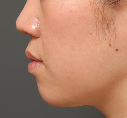 30代女性の鼻翼拳上 Before 症例写真