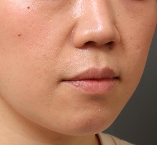 30代女性の鼻翼拳上 Before 症例写真