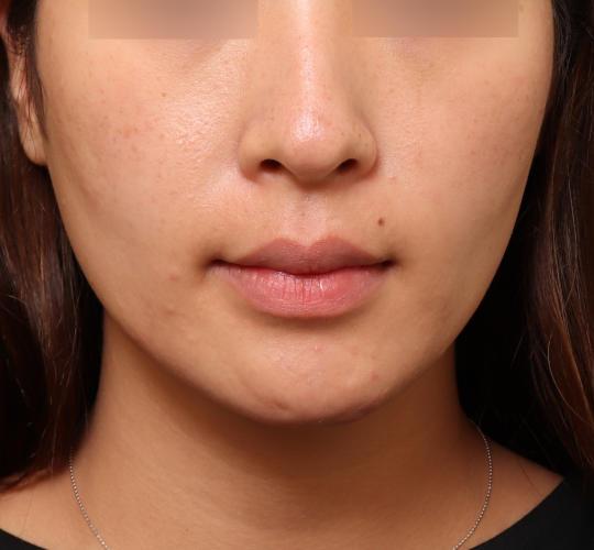 20代女性のボトックス(小顔) After 症例写真