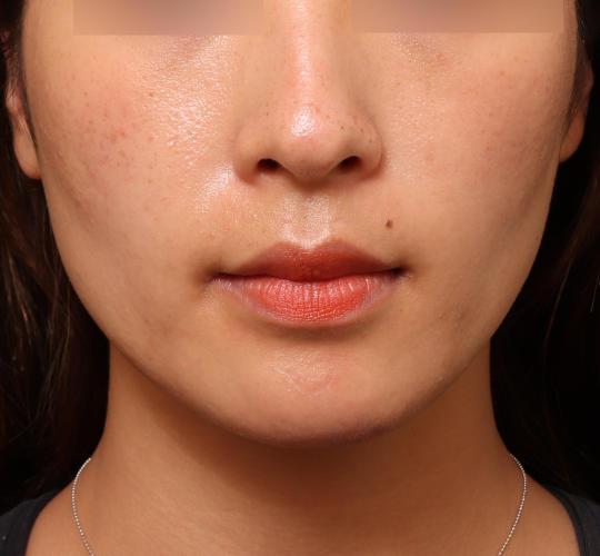 20代女性のボトックス(小顔) Before 症例写真