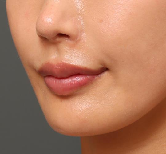 20代女性の人中短縮ボトックス After 症例写真