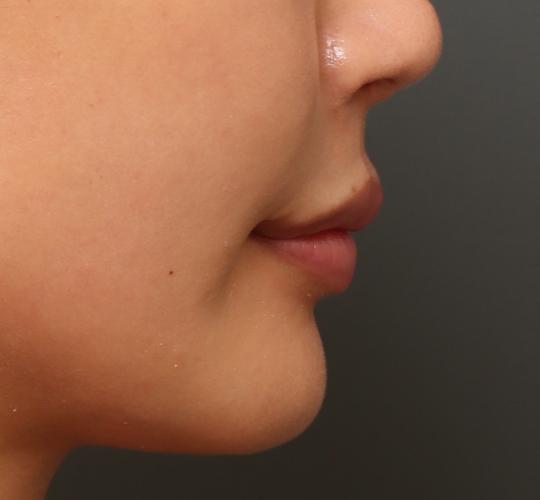 20代女性の人中短縮ボトックス After 症例写真