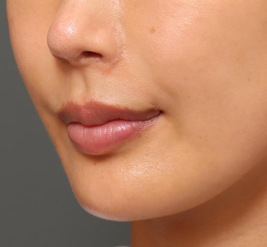 20代女性の人中短縮ボトックス Before 症例写真