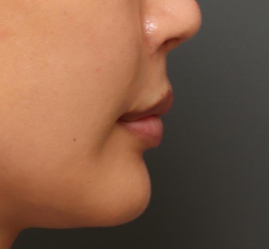 20代女性の人中短縮ボトックス Before 症例写真