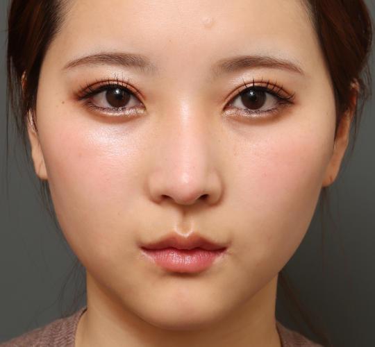 20代女性の二重整形・目元の整形 After 症例写真
