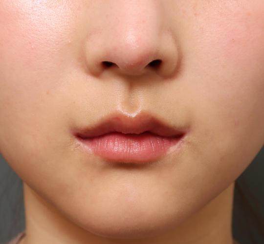 20代女性の目つき矯正 After 症例写真