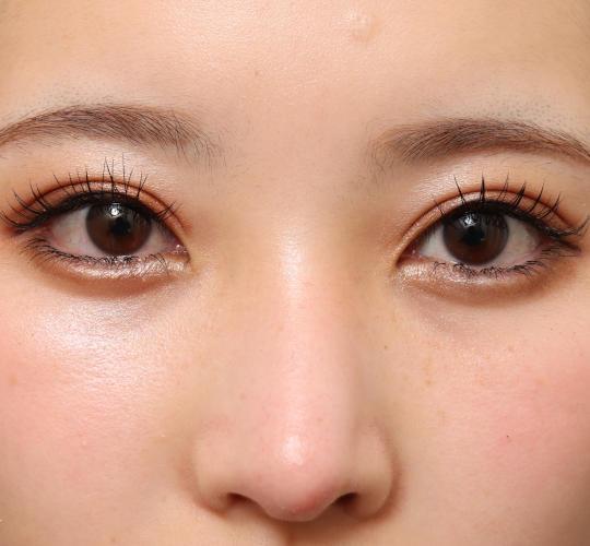 20代女性の目つき矯正 After 症例写真