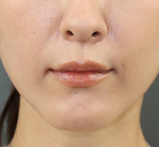 40代女性のヒアルロン酸注射(唇) After 症例写真