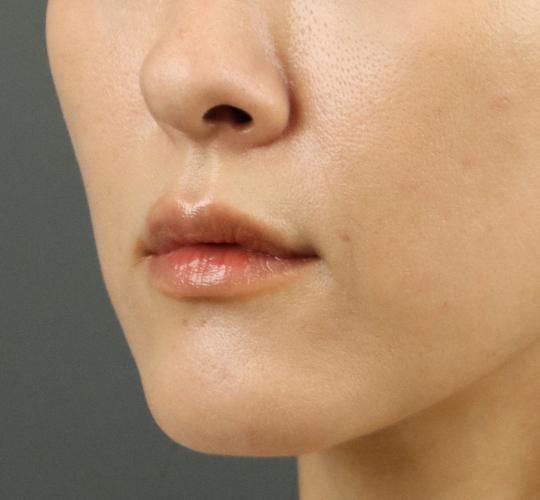 40代女性のヒアルロン酸注射(唇) After 症例写真