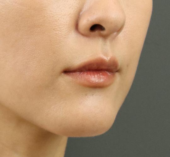 40代女性の人中短縮ボトックス After 症例写真