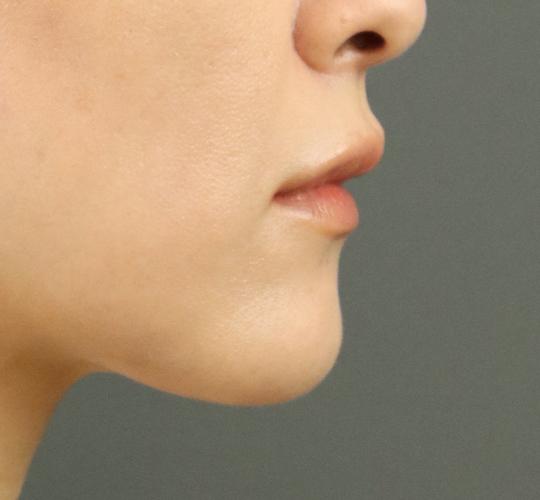 40代女性のヒアルロン酸注射(唇) After 症例写真