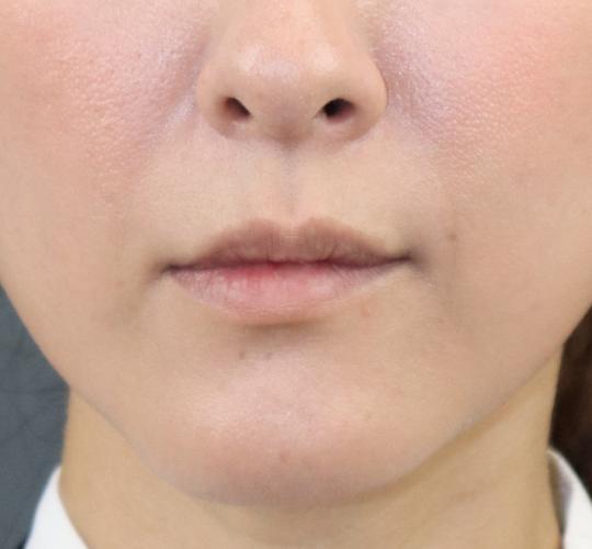 40代女性のヒアルロン酸注射(唇) Before 症例写真