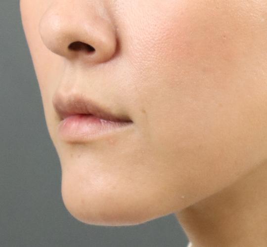 40代女性のヒアルロン酸注射(唇) Before 症例写真